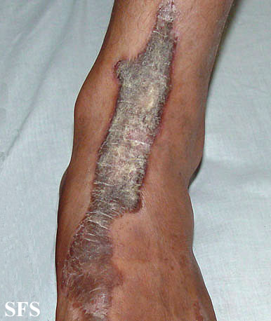 Inflammatory linear verrucous naevi-bilateral. Adapted from Dermatology Atlas.[3]