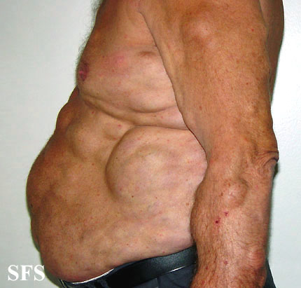 Steroid skin injection