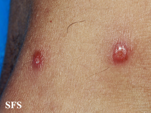 Rosai-dorfman disease. Adapted from Dermatology Atlas.[4]