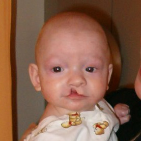 3 months old boy before going into surgery to have his unilateral incomplete cleft lip repaired.