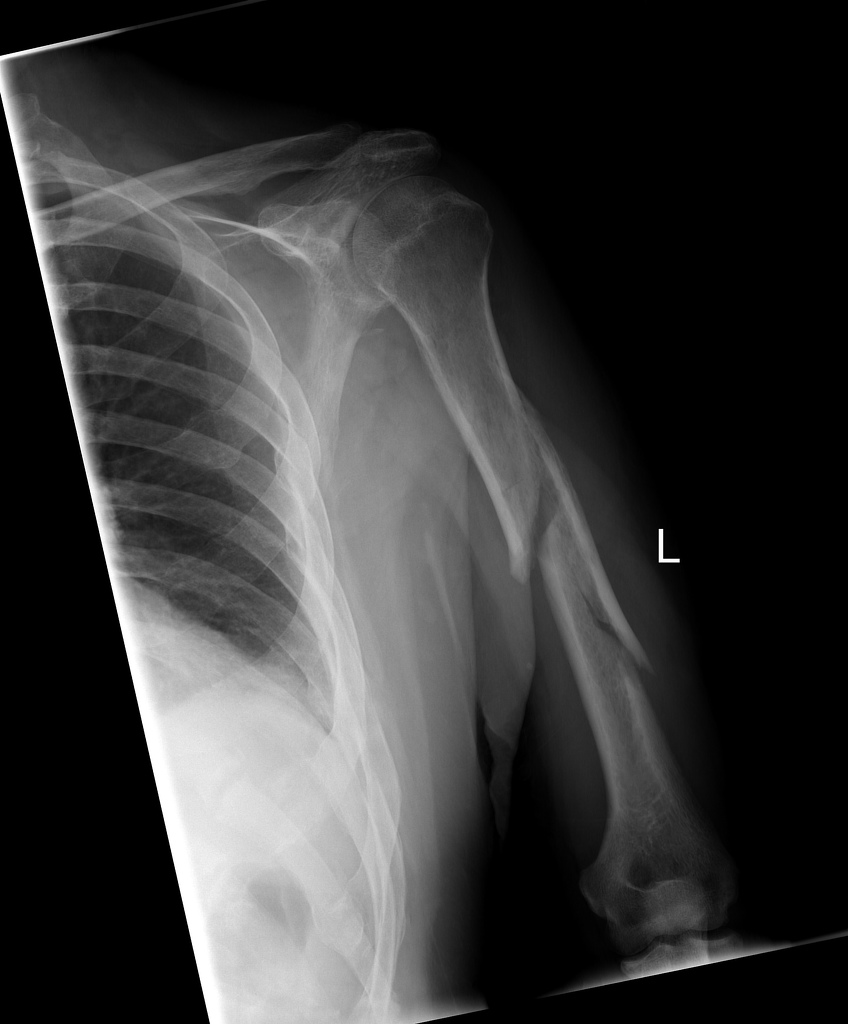 Humeral shaft fracture with displacement of fragments and a "butterfly fragment".