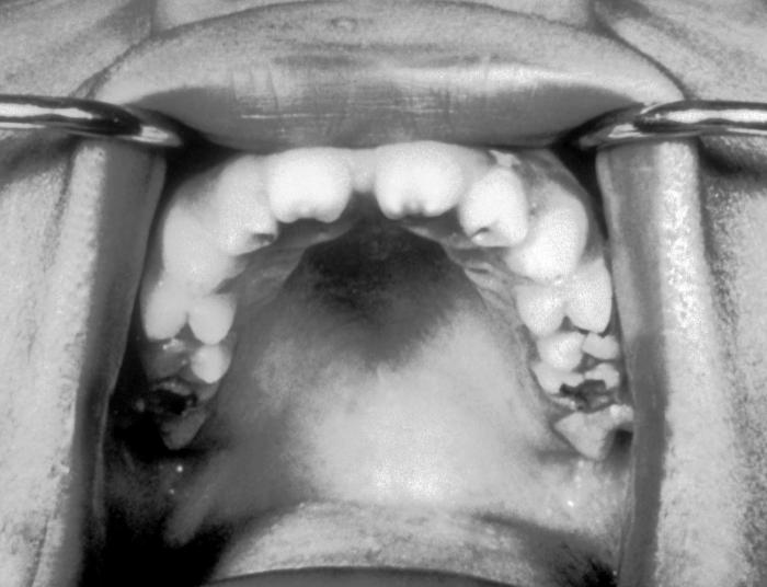 A photograph of Hutchinson’s Teeth resulting from congenital syphilis. Hutchinson’s Teeth is a congenital anomaly in which the permanent incisor teeth are narrow and notched. Note the notched edges and "screwdriver" shape of the central incisors. Adapted from CDC