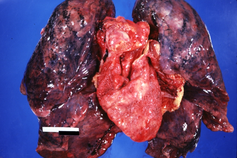 Neoplastic pericarditis: Gross, natural color, shaggy pericarditis. Primer is adenocarcinoma of the lung.