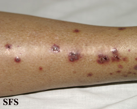 File:Allergicvasculitis12.jpg