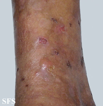 File:Dermatitis herpetiformis14.jpg