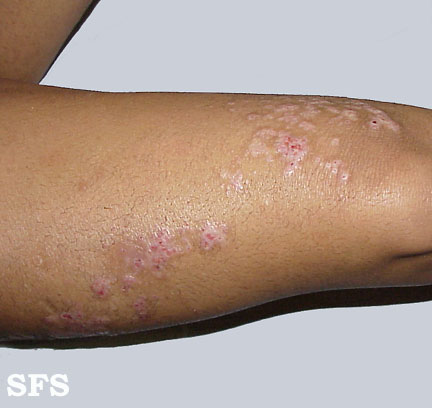 Inflammatory linear verrucous naevi. Adapted from Dermatology Atlas.[3]