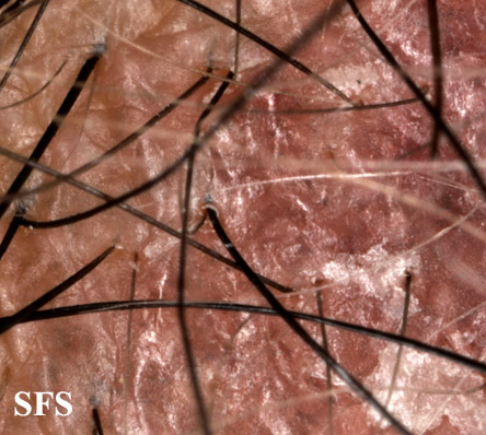 Lichen planus follicularis. Adapted from Dermatology Atlas.[1]