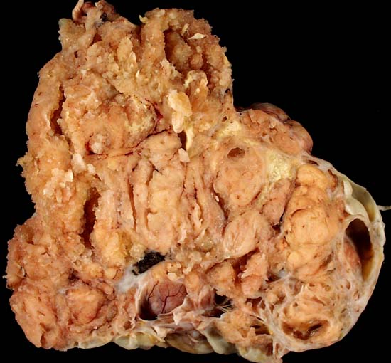 Serous cystadenocarcinoma of the ovary.