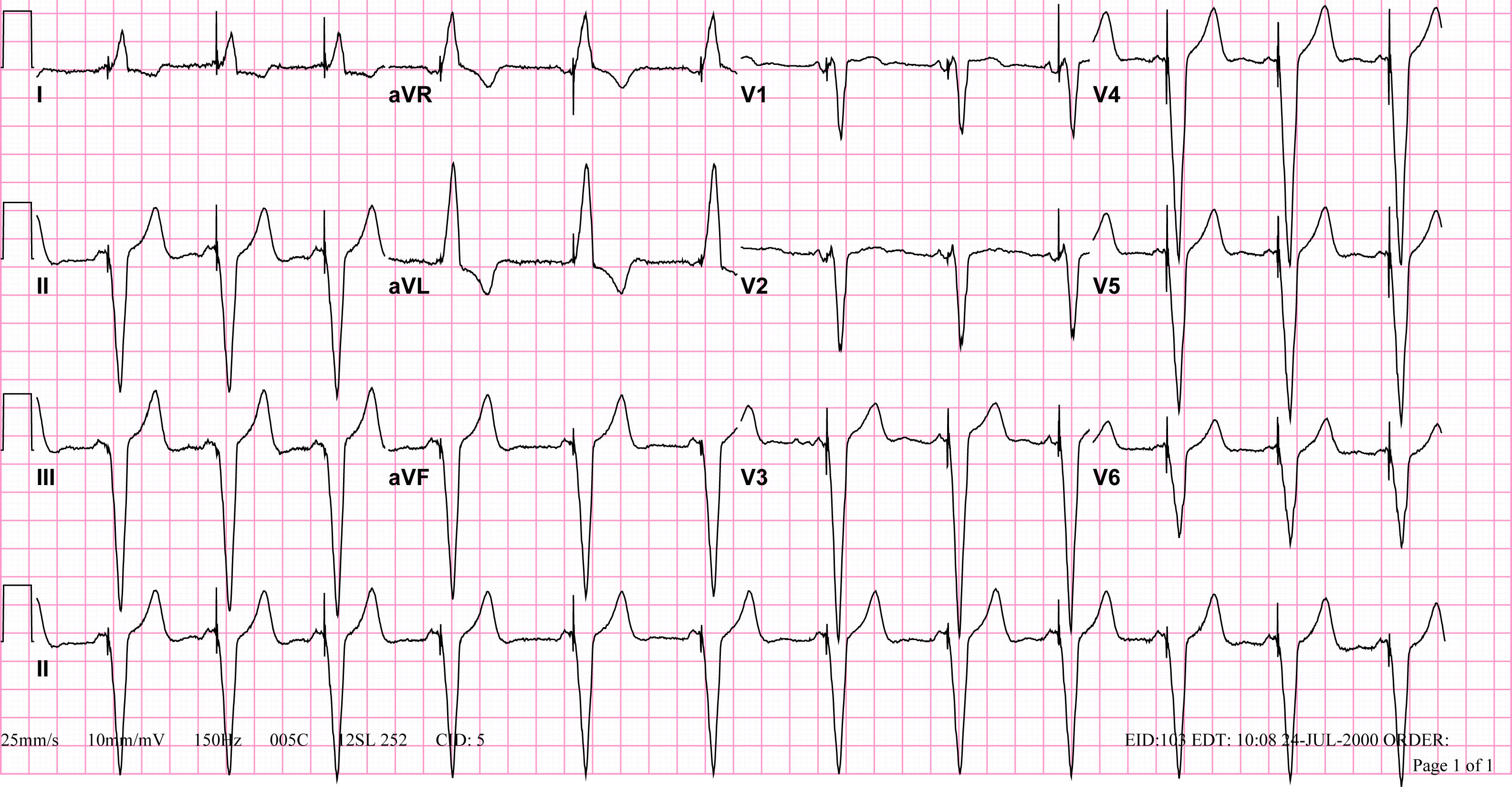 VVI pacemaker rhythm. Note the LBBB morphology with left axis deviation indicating the pacing lead in the right ventricular apex.