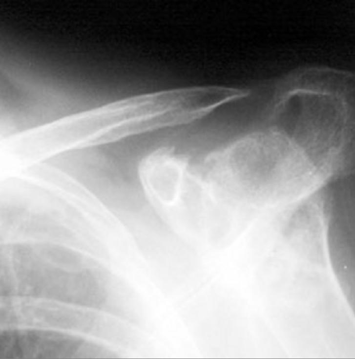 Distal clavicle reabsorption
