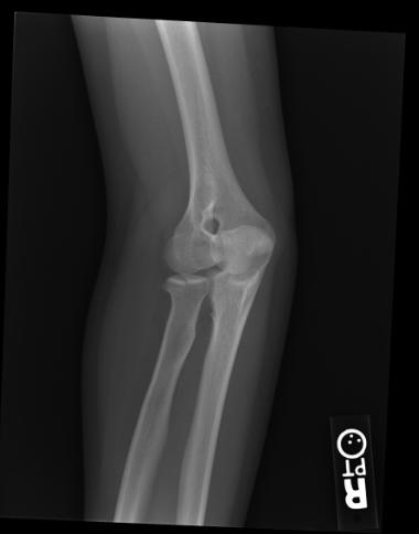 Radiograph demonstrates radial head fracture and joint effusion Image courtesy of RadsWiki and copylefted
