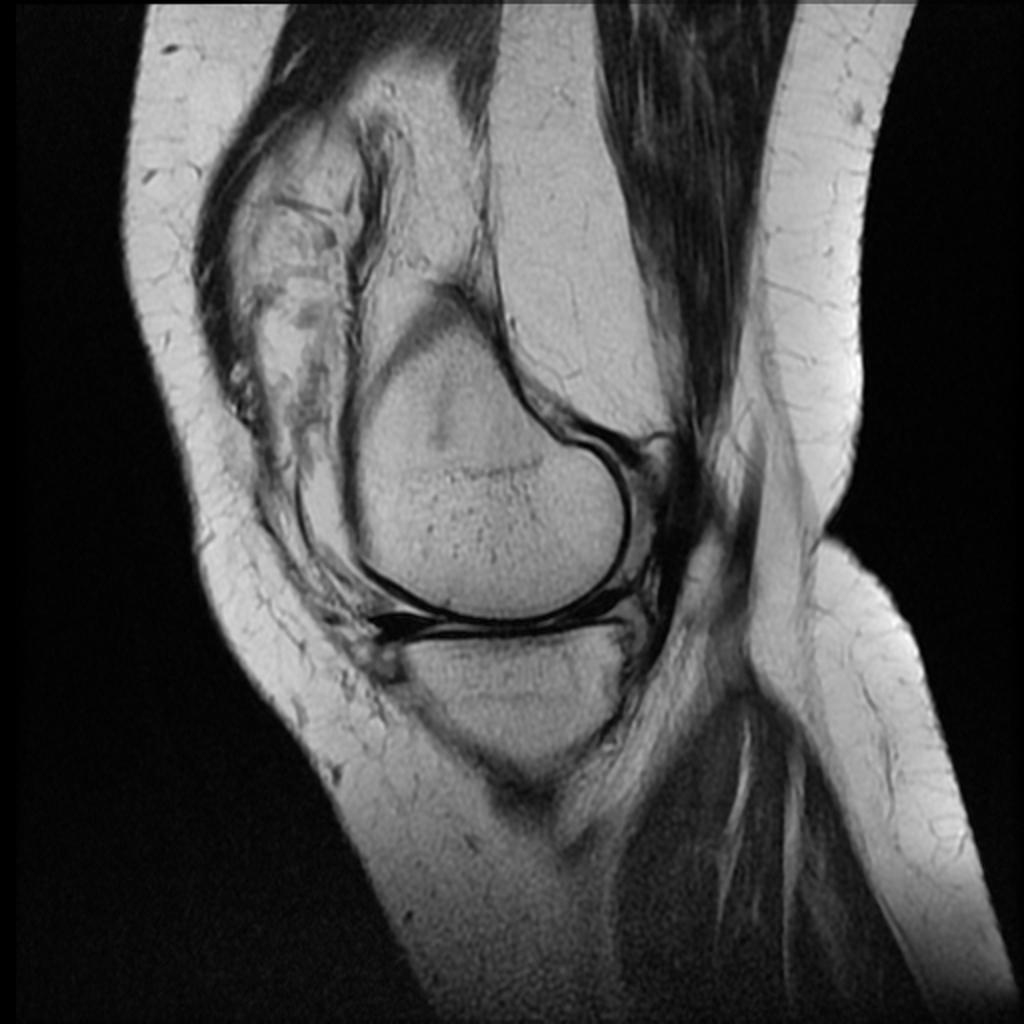 File:Rheumatoid-arthritis-of-the-knee-1 (1).jpg