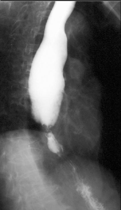 Barium graphy: Lower esophageal sphincter involvement. (Image courtesy of RadsWiki and copylefted)