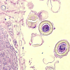 Higher magnification of the image in Figure 2, showing a close-up of the eggs. Note the characteristic striations, typical for the taeniids. Not visible in these images are the hooks commonly seen in cestode eggs. Hooks do not stain with H&E but are refractile and are visible with fine focusing of the microscope. Adapted from CDC