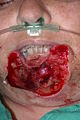 Immeadiate post-procedure after Mohs surgery resection of lower lip squamous cell carcinoma