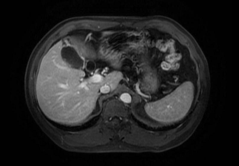File:Adenomyomatosis MRI 003.jpg
