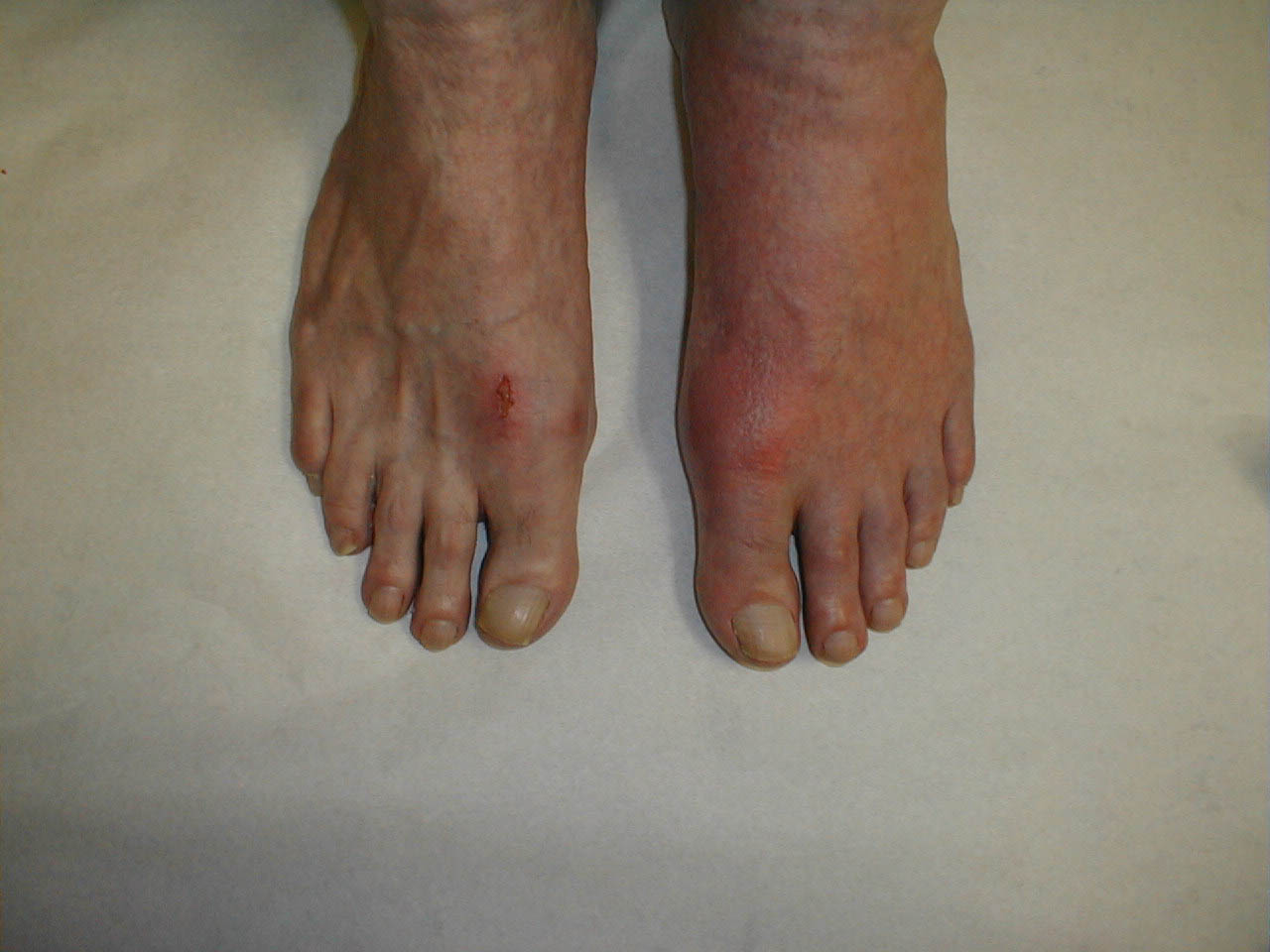 Gout of the Left Great Toe: Diffuse swelling and redness centered at the left MTP joint.