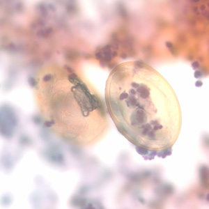 Eggs of P. kellicotti in a Pap-stained bronchial alveolar lavage (BAL) specimen at 400x magnification. Image courtesy of Dr. Gary Procop. Adapted from CDC