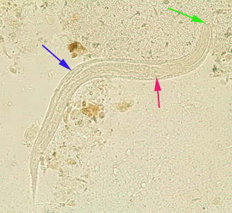 Rhabditiform larva of S. stercoralis in an unstained wet mount of stool. Notice the prominent genital primordium (blue arrow), rhabditoid esophagus (red arrow) and short buccal canal (green arrow). Adapted from CDC