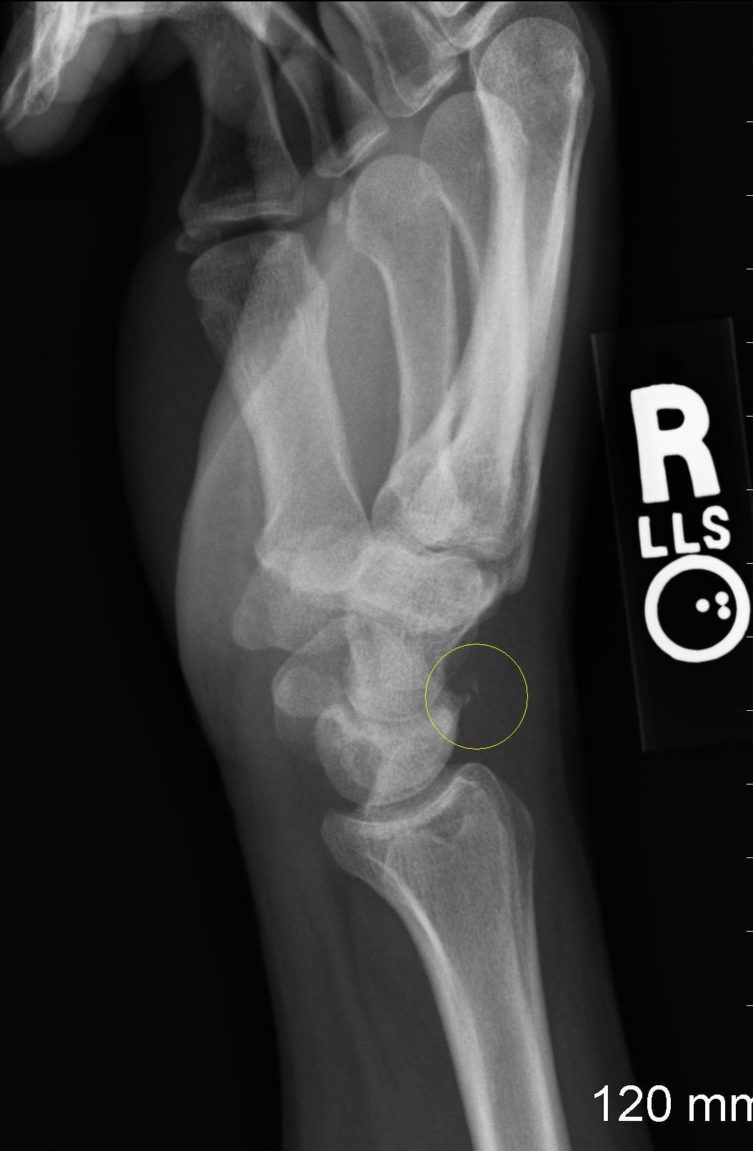 Avulsion fracture off lunate bone