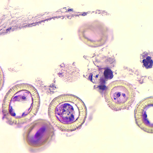 Higher magnification of the image in Figure 2, showing a close-up of the eggs. Note the characteristic striations, typical for the taeniids. Not visible in these images are the hooks commonly seen in cestode eggs. Hooks do not stain with H&E but are refractile and are visible with fine focusing of the microscope Adapted from CDC