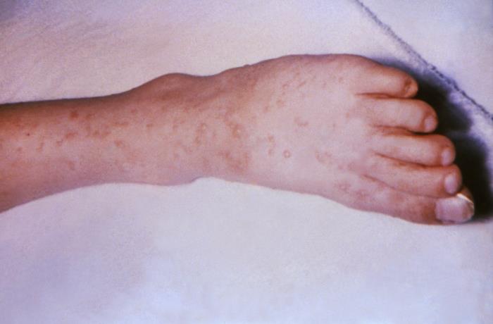 This patient presented with a generalized Herpes hominis vesiculopapular rash over the dorsum of the left foot. Herpesvirus hominis, otherwise known as “herpes simplex virus” is a member of a group of viruses including those which cause oral herpes, i.e., usually HSV-1, and genital herpes, i.e., usually HSV-2. Adapted from CDC