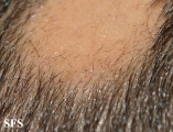 File:Alopecia areata 19.jpeg