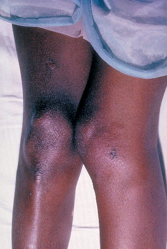 Lesions of skin and arthritic knee joints due to Neisseria gonorrhea