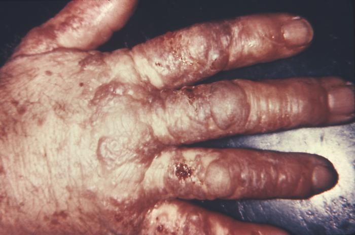 This patient presented with what was first thought to be syphilis, but turned out to be seborrheic dermatitis. This condition of the skin occurs in area of the body where the sebaceous glands experience an over-production of sebum, and subsequently gives rise to an infection and inflammation. Other causes include fungal involvement by a form of the yeast, Malassezia, having a genetic predisposition to this condition, hormonal changes disrupting the skin’s normal physiology, generalized stress, illness, fatigue, and sleep deprivation. Adapted from CDC