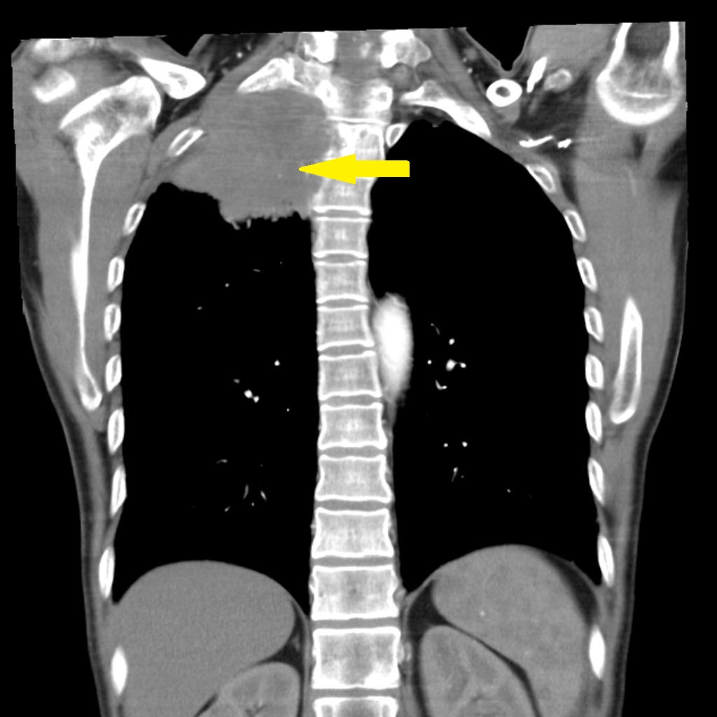 File:Pancoast-tumour-with-cystic-cerebral-metastasis (1).jpg