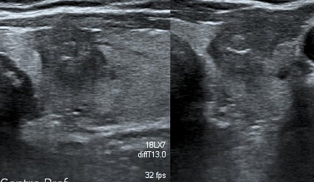 File:Papillary thyroid cancer ultrasound 3.jpeg