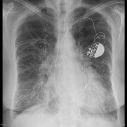 File:Acute pulmonary edema with Kerley B lines.jpg