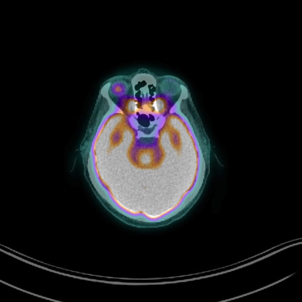 File:Choroidal melanoma on FDG PET CT.jpg