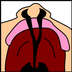 Bilateral complete lip and palate