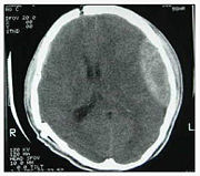 Epidural hematomas usually look convex on CT scans