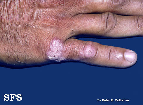 Tuberculosis verrucosa cutis. Adapted from Dermatology Atlas.[3]