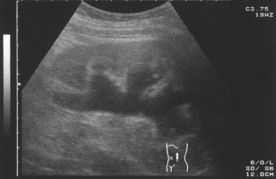 Ultrasound picture of hydronephrosis caused by a left ureteral stone