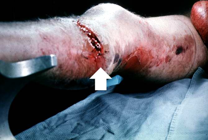 This gross photograph of the lower extremity was taken at autopsy. Notice the swelling and the area of the primary infection (arrow).