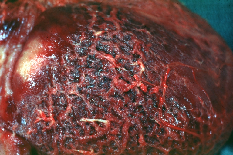 Fibrinous pericarditis: Gross, an excellent example, close-up view.
