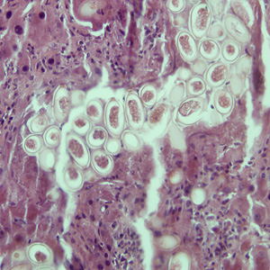 Eggs of C. hepatica in liver stained with hematoxylin and eosin (H&E). Adapted from CDC