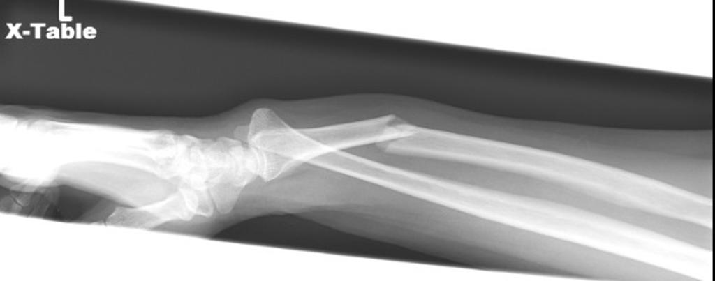 File:Galeazzi-fracture-dislocation-3 (1).jpg