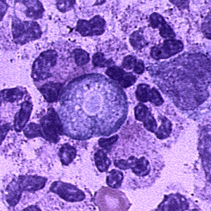 Trophozoite of N. fowleri in CSF, stained with hematoxylin and eosin (H&E). Adapted from CDC