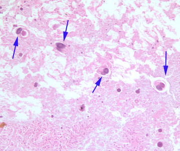 Cross-sections of female S. stercoralis (blue arrows) in small intestine tissue, stained with H&E. Image taken at 200x magnification. Adapted from CDC