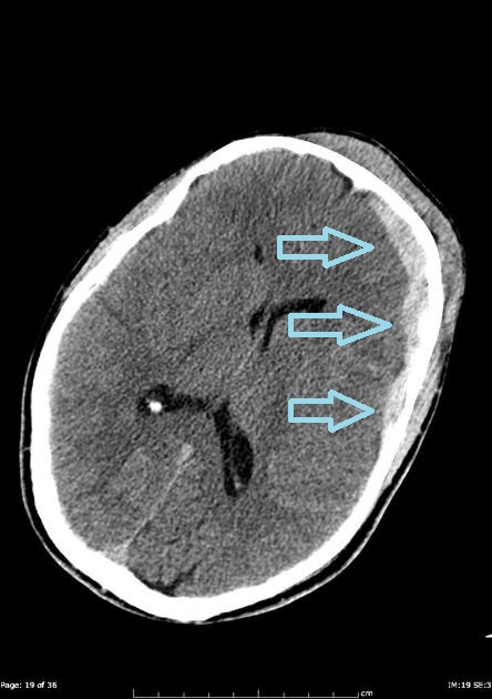 File:Acute subdural CT.jpg