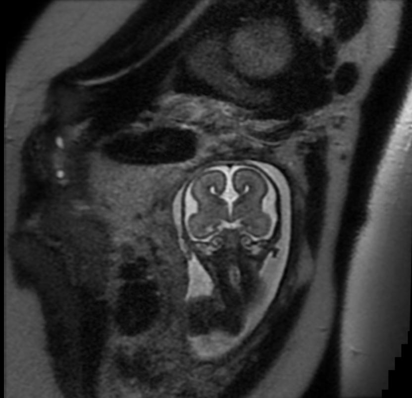 File:Agenesis of the corpus callosum fetal MRI 004.jpg
