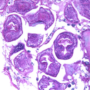 Echinococcus multilocularis in liver tissue, stained with hematoxylin and eosin (H&E). Magnification at 200x Adapted from CDC