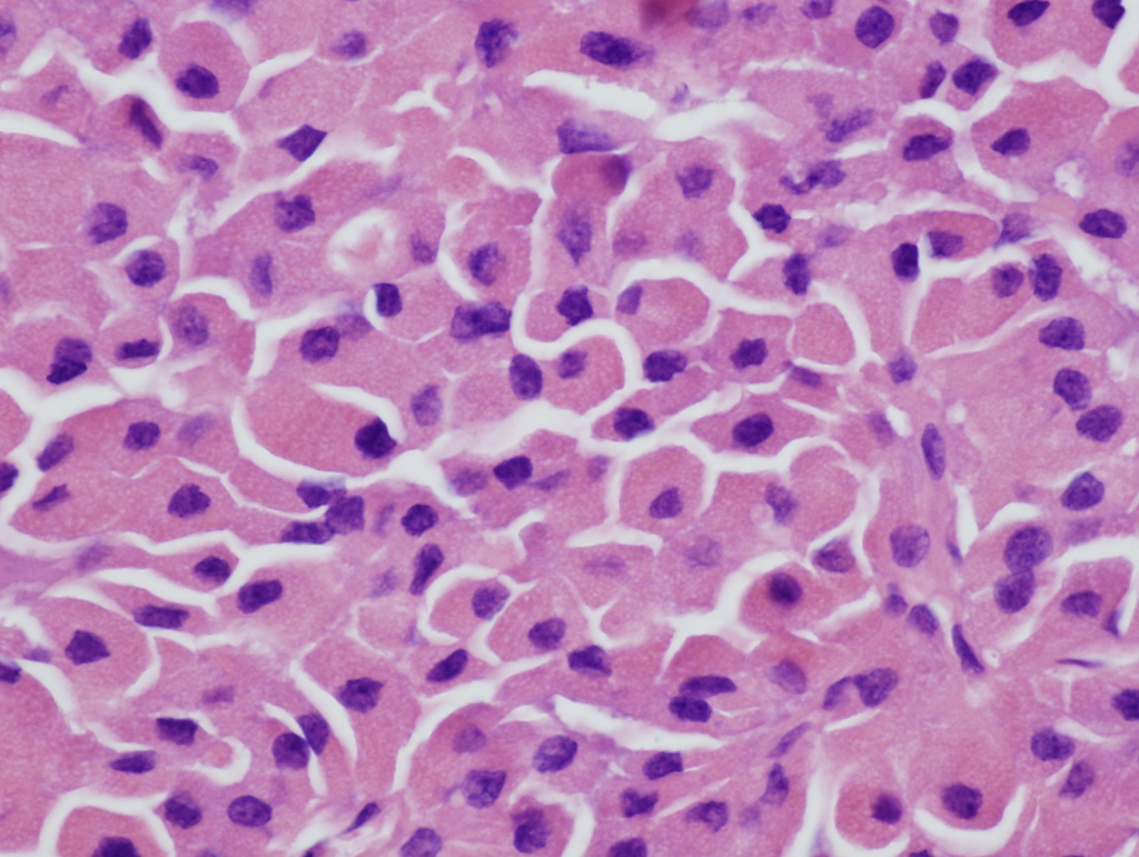 File:Hurthle cell adenoma-histology 40x H&E.jpg