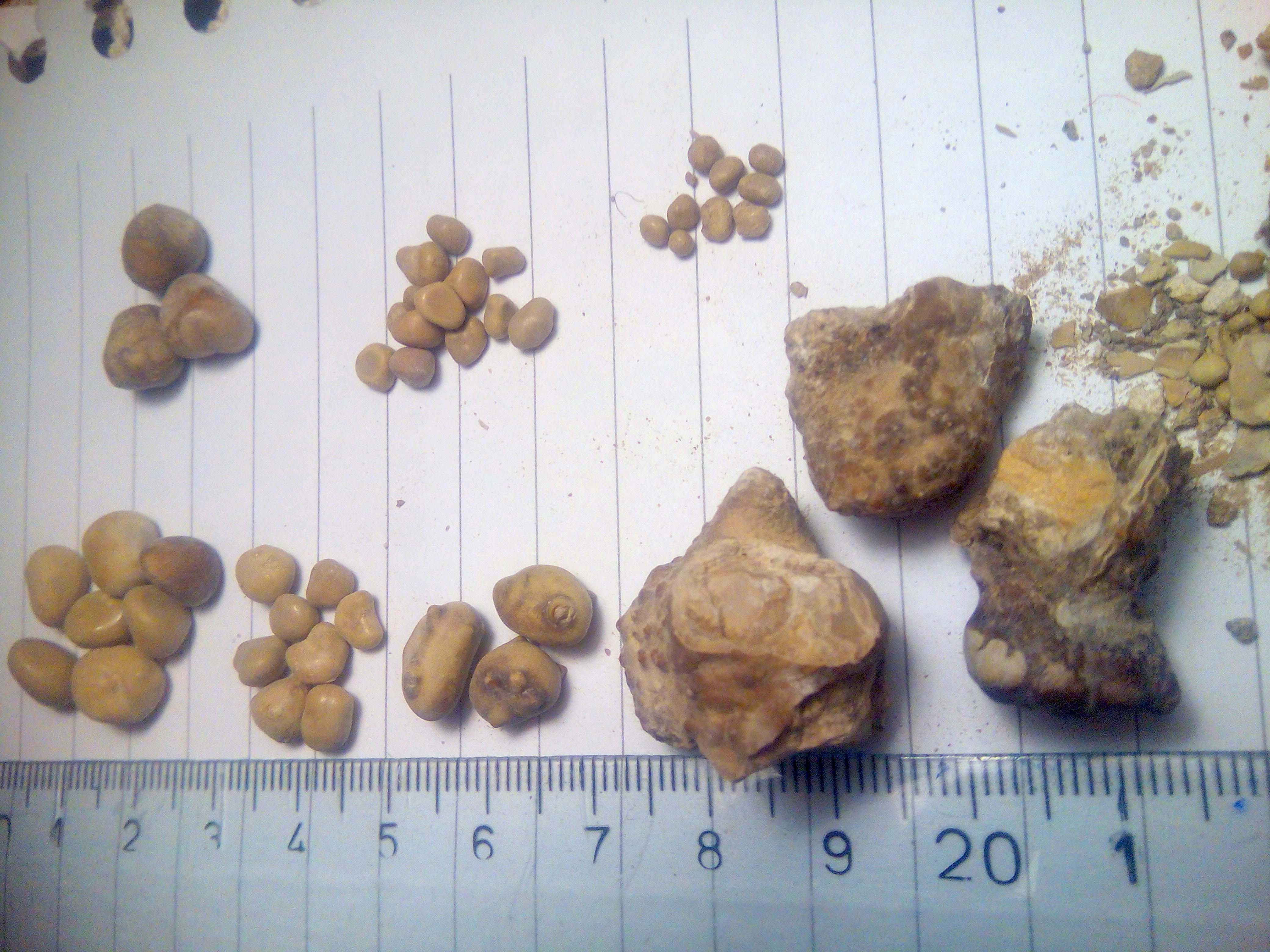 Renal calculi, different shapes and sizes, Source: Wikimedia commons[4]
