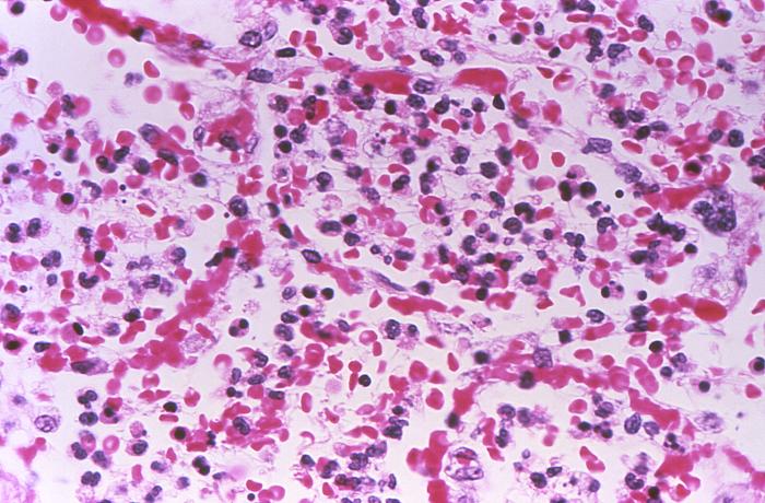 Histopathology of lung in a case of fatal human plague pneumonia.Adapted from Public Health Image Library (PHIL), Centers for Disease Control and Prevention.[15]