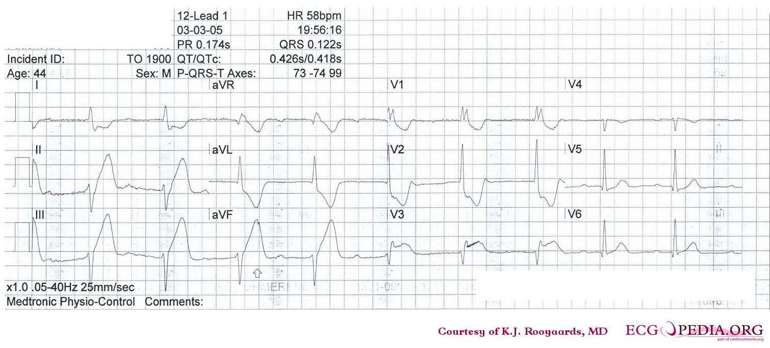 Inferior-posterior myocardial infarction with complete AV block and ventricular excape rhythm with RBBB pattern and left axis, followed by sinus rhythm.